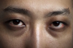 allergic shiners eyes allergies dark brown nose rhinitis